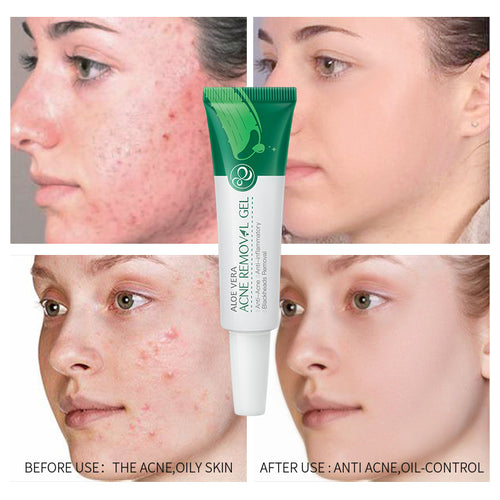 Aloe Acne Care Gel - Soothing Face Cream Serum Pore Minimizer