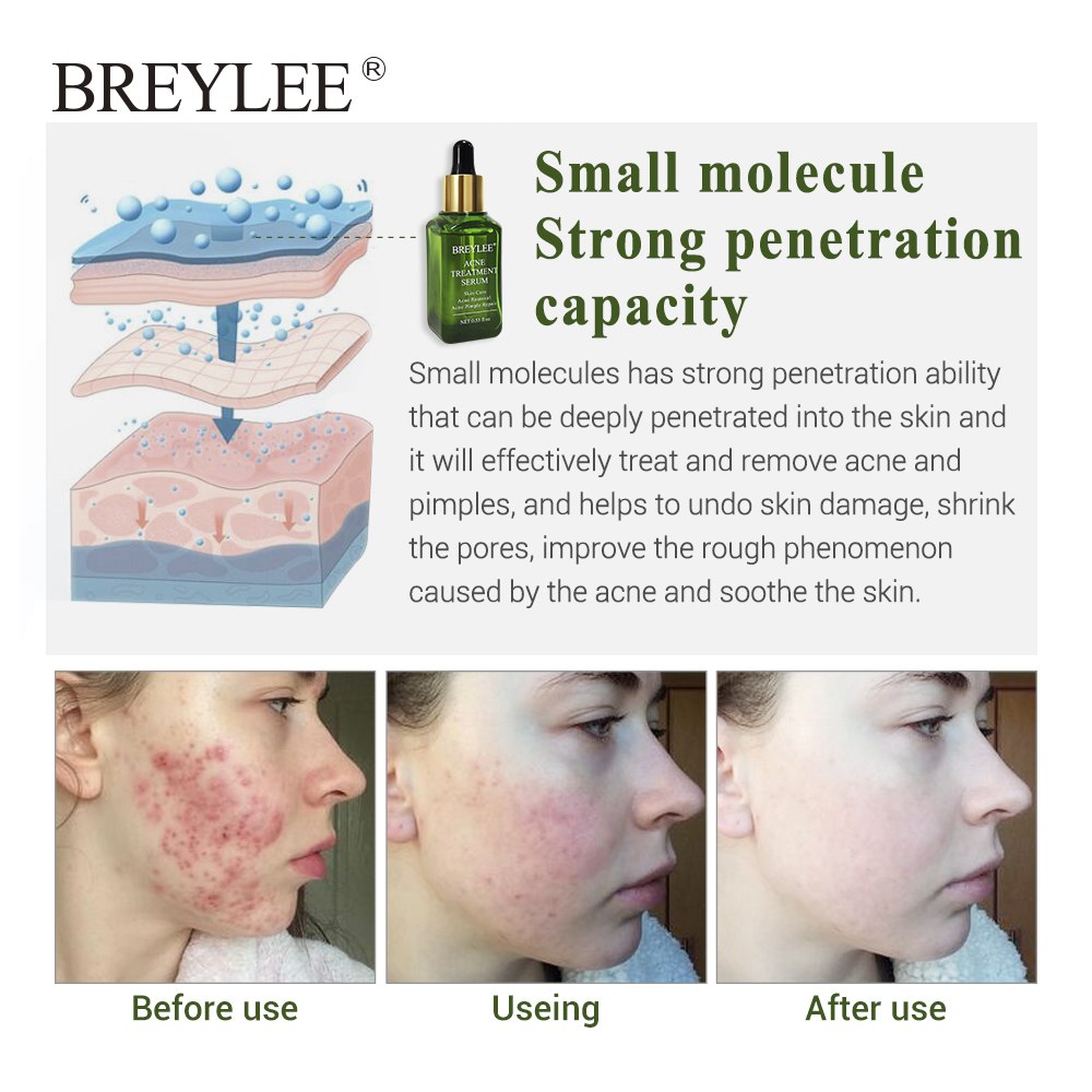 BREYLEE Acne Care Serum - Anti Acne Scar Removal Cream Skin Whitening