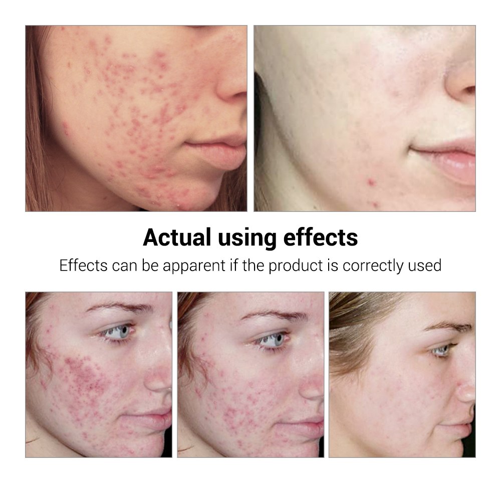 BREYLEE Acne Care Serum - Anti Acne Scar Removal Cream Skin Whitening