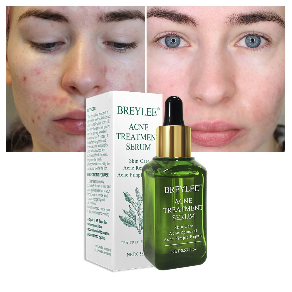 BREYLEE Acne Care Serum - Anti Acne Scar Removal Cream Skin Whitening