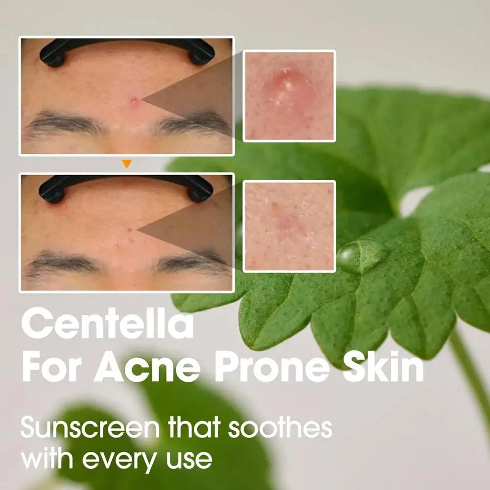 Korean SOME BY MI AHA BHA PHA Tea Tree Cream Set - Acne Care Skincare Set
